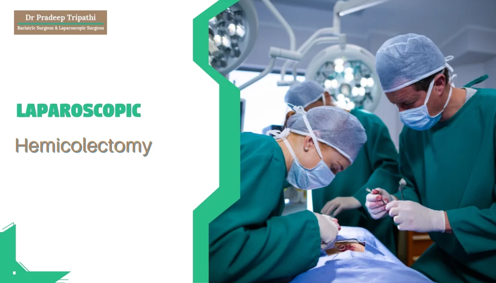 Laparoscopic Hemicolectomy