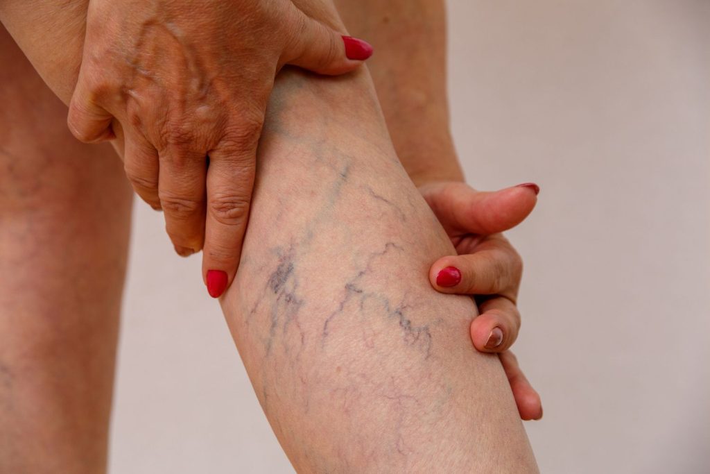 Best Doctor for Varicose Veins in Thane