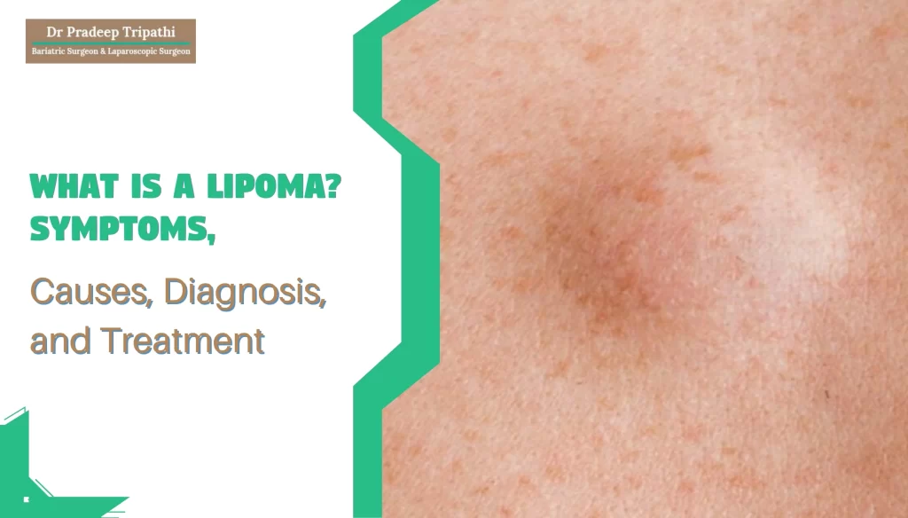 What is Lipoma? Symptoms, Causes, Diagnosis and Treatment