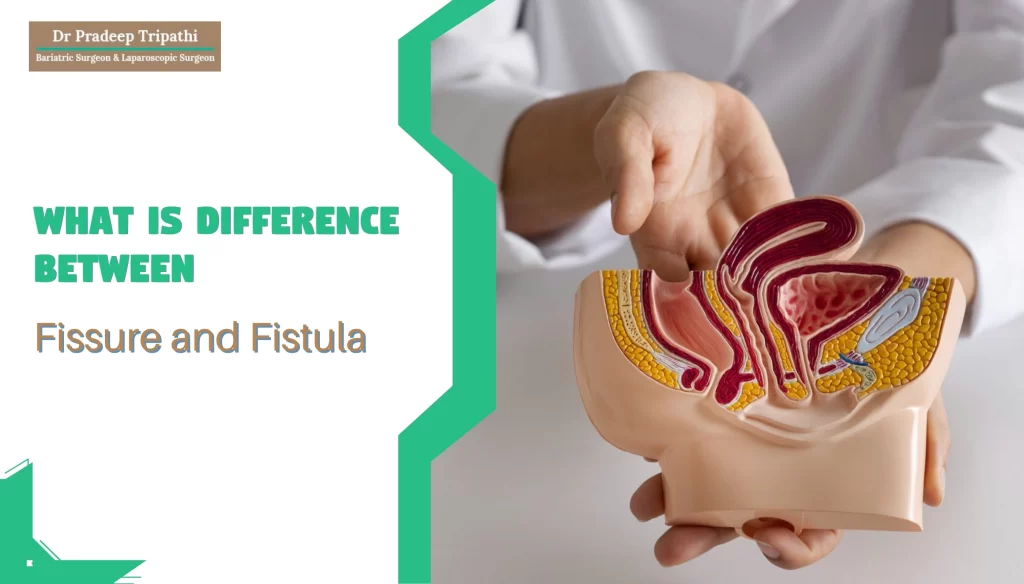 What is Difference Between Fissure and Fistula