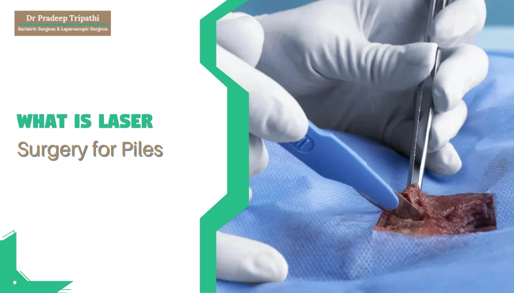 What is Laser Surgery for Piles